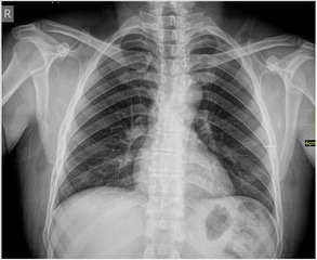 Baryumlu Mide Grafisi Nedir ve Nasıl Çekilir?