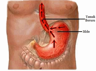 Mide Çürümesi Belirtileri ve Tedavisi