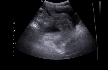 Mide Duvarı Kalınlaşması