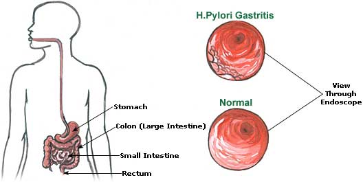 Gastritin Belirtileri